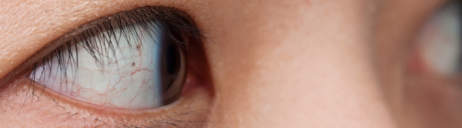 Descolamento de Retina