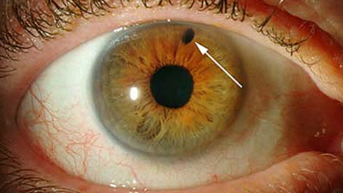 Dr. Rafael Merola publica artigo sobre glaucoma em revista eletrônica de oftalmologia